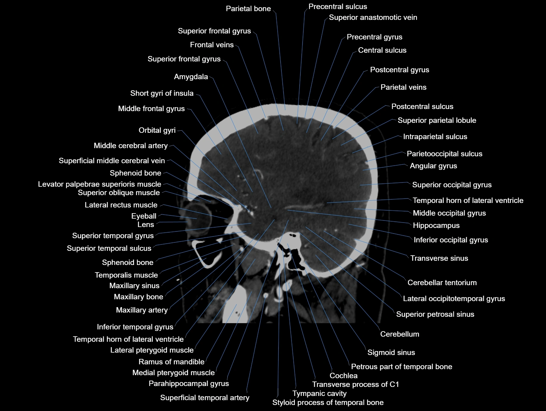 CT scan brain sagittal cross sectional anatomy image-img-00001-00023.webp